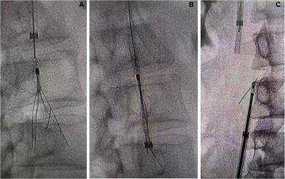 Case report: Endoluminal removal of a retrievable conical inferior vena cava filter with a ruptured retraction hook attached to the wall